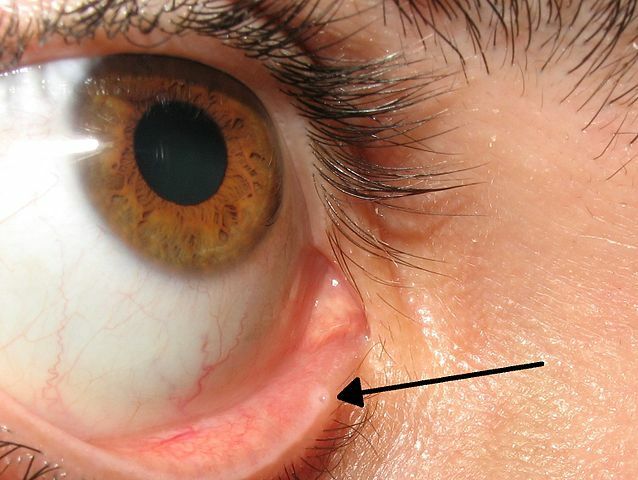 638px Lacrimal punctum